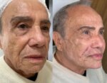 conheca-os-riscos-da-harmonizacao-facial-realizada-por-stenio-garcia